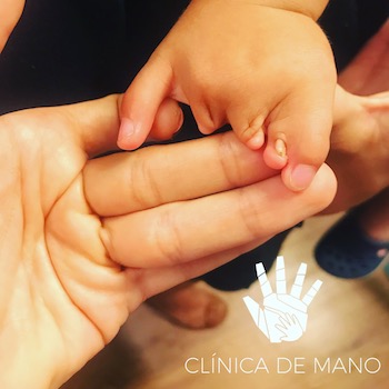 Sindrome de Bridas Amnióticas